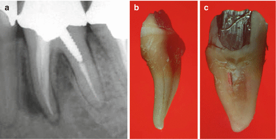 Etiology Of Vertical Root Fractures Pocket Dentistry