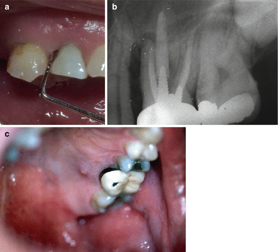 Isolated deep pocket associated with vertical root fracture and