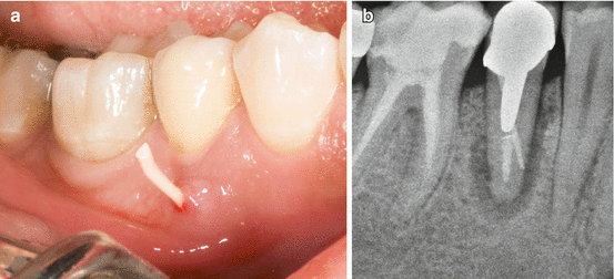 Vertical Dental Fracture Present Status And Future Directions 