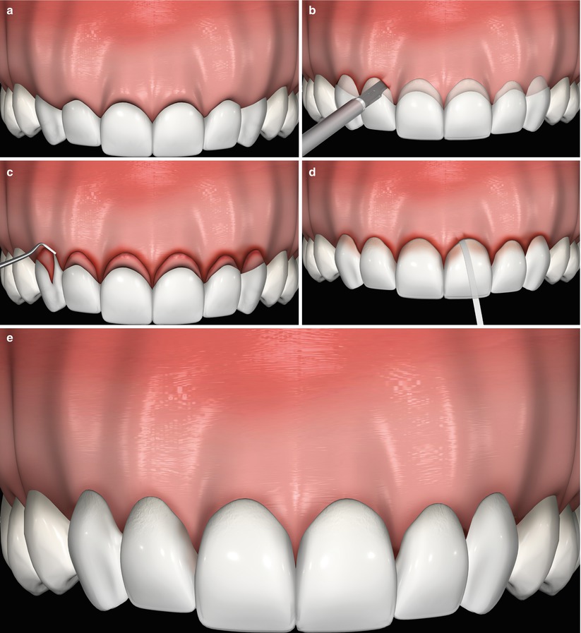 Esthetical clinical crown lengthening, lip repositioning, and gingival