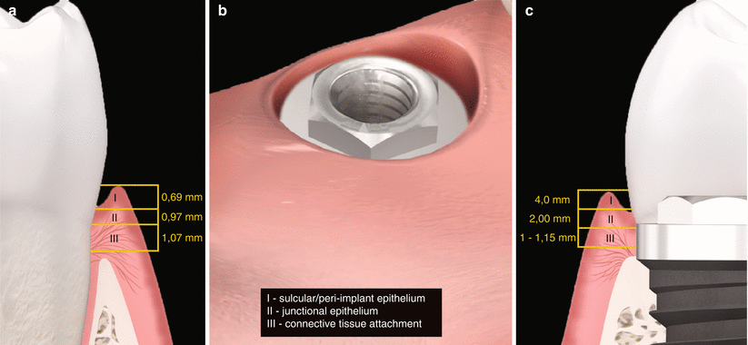 Peri-implant Plastic Surgery