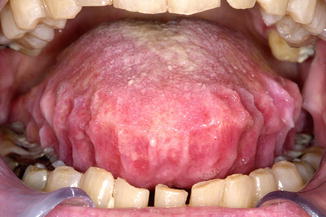 Diseases of the Tongue | Pocket Dentistry