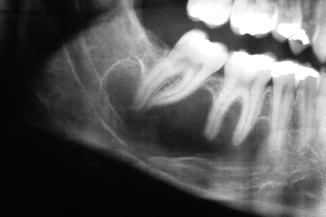 Diseases Of The Jaw Bones Pocket Dentistry