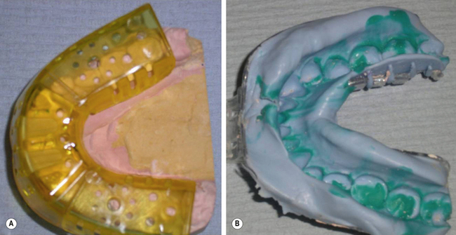 agar dental impression material