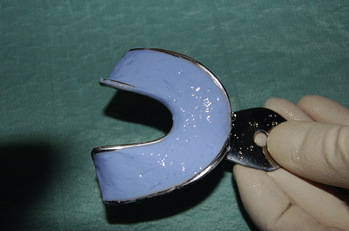 alginate impression material for dentures