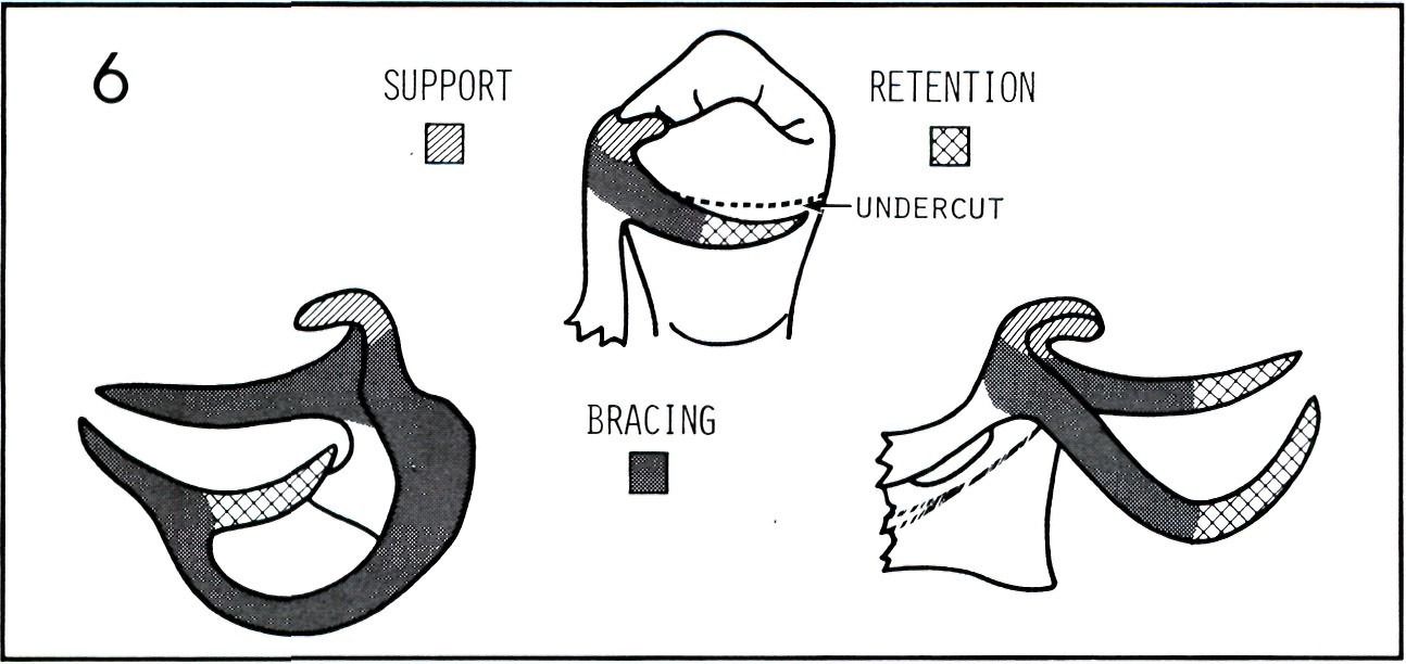 Removable Partial Denture Design, | Pocket Dentistry