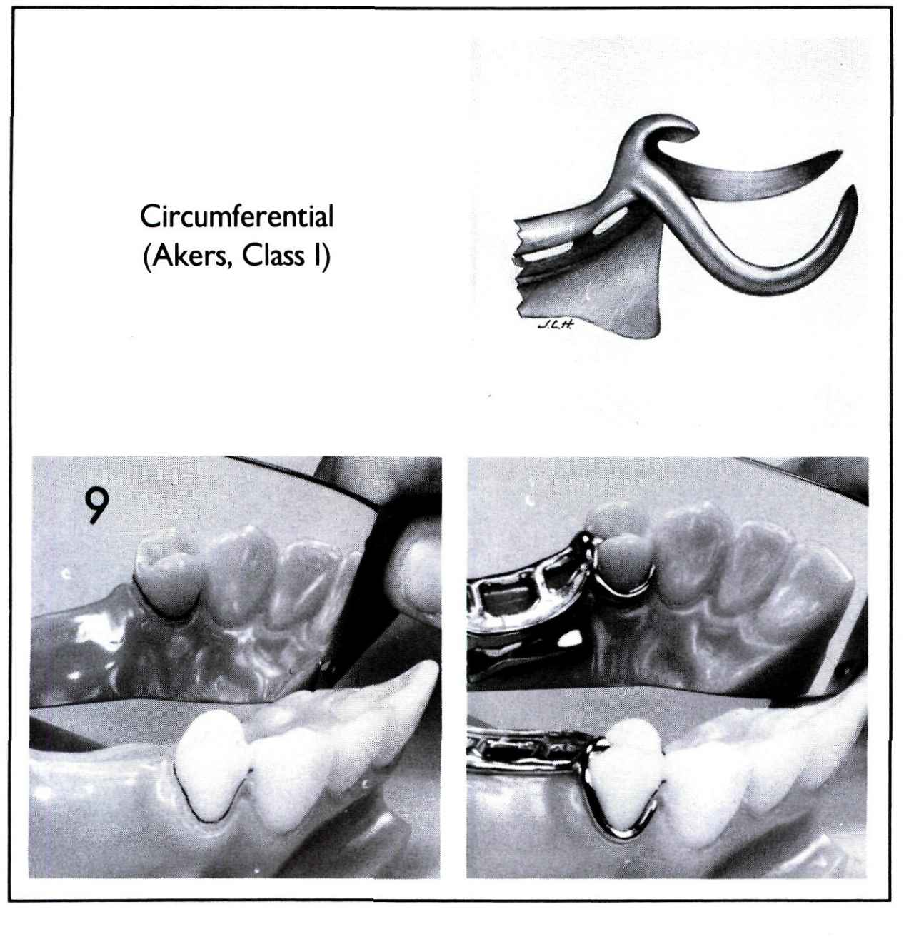 Partial Denture Clasp Types