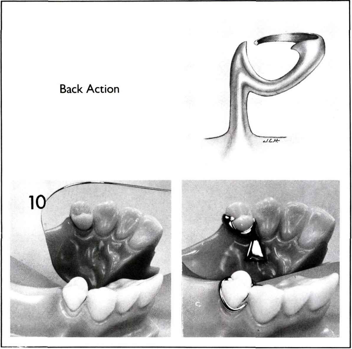 Removable Partial Denture Design