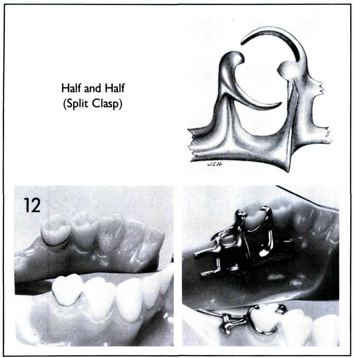 Types Of Removable Partial Denture Clasps - Design Talk