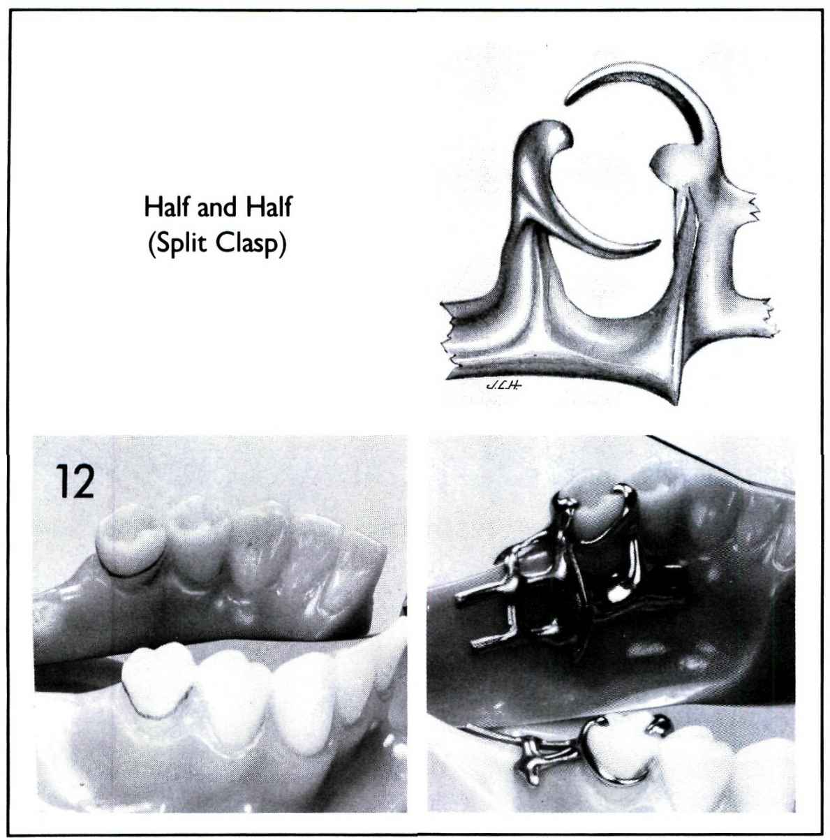 Removable Partial Denture Design, Pocket Dentistry