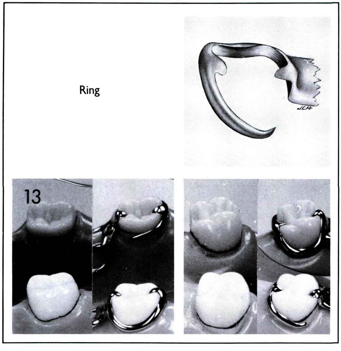 Removable Partial Denture Design