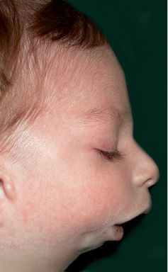 Craniofacial Growth In First And Second Branchial Arch Syndromes