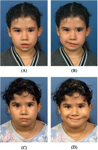 Facial Nerve Paralysis and its Management Pocket Dentistry