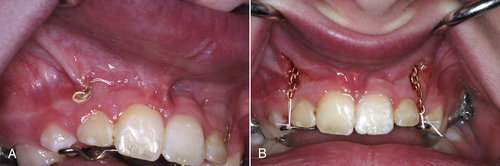 EFFECT OF GINGIVECTOMY ON MEAN EXPOSED LINGUAL OR PALATAL ROOT SURFACE