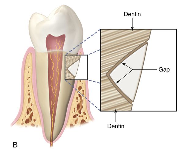 Composite resin: Fundamentals and direct technique restorations