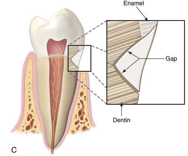 Easy Steps For Successful Light Curing Of Composite Resin