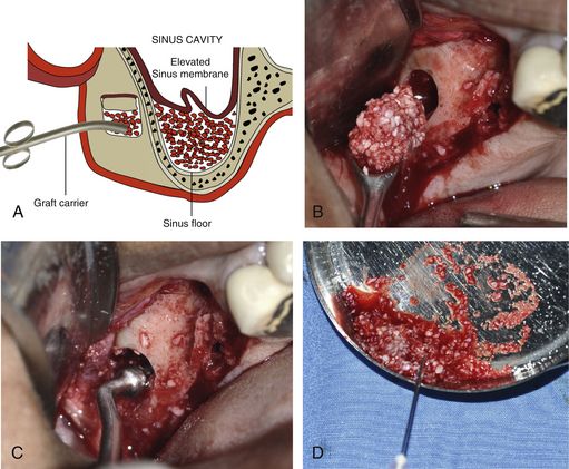 Sinus grafting for dental implants | Pocket Dentistry