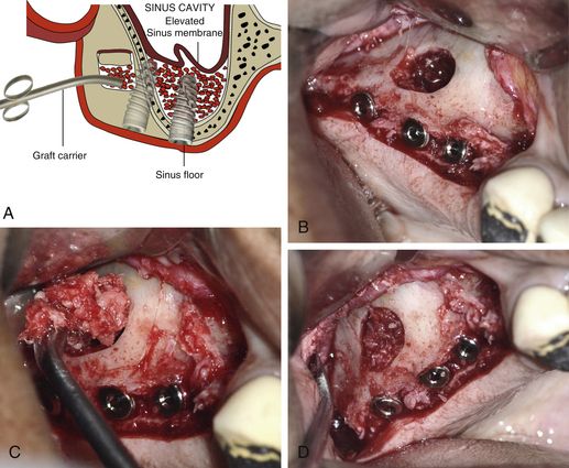 税込】 The Sinus ザサイナスボーングラフト Graft Bone 健康/医学 