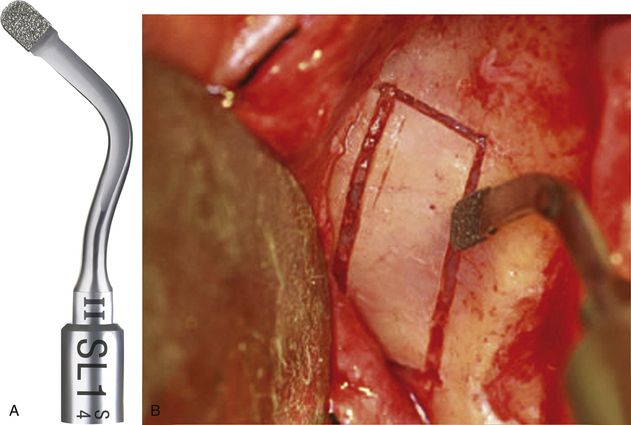 Sinus grafting for dental implants | Pocket Dentistry