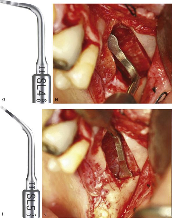 Sinus grafting for dental implants | Pocket Dentistry