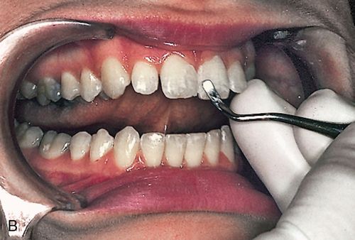 a-d, Silicone indexes from wax-up. Incisal(e) and facial(f) views