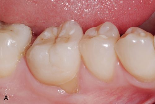 Partial Coverage or Full Coverage: What Is Best for Your Tooth