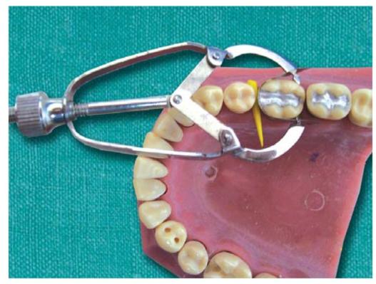 Principles Of Tooth Preparation Pocket Dentistry