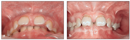 Labial Frenulum Normal