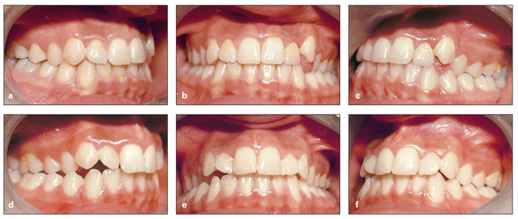 Management Of Transverse Problems Posterior Crossbites Pocket Dentistry