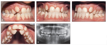 Management of Transverse Problems Posterior Crossbites Pocket