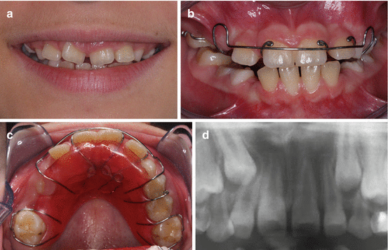 Treatment Options Timing And Sequencing Orthodontics Pocket Dentistry