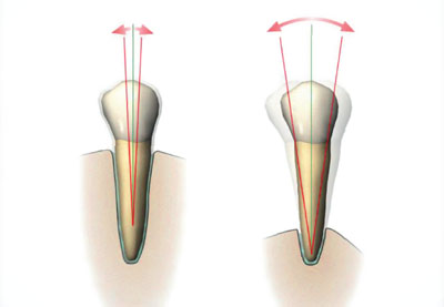 excursion tooth definition