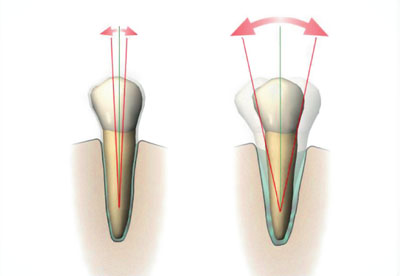 excursion definition in dentistry