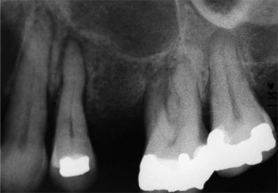 excursion definition in dentistry