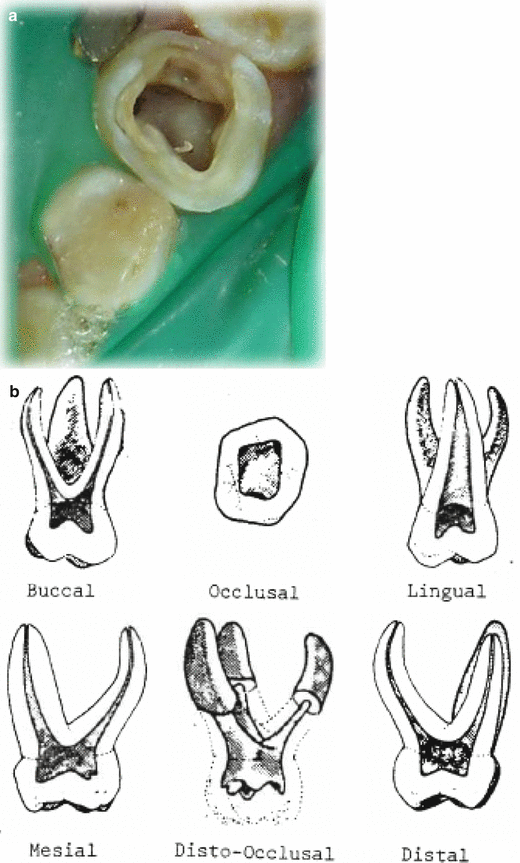 Baby Teeth Root Canals On