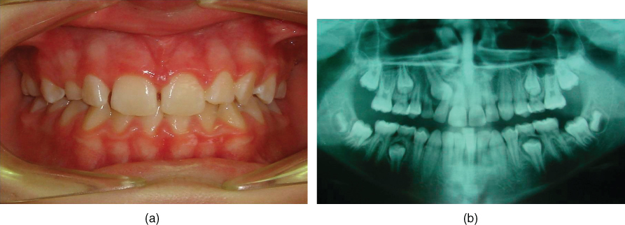 Ectopic Eruption Of Maxillary Permanent Canines Pocket Dentistry