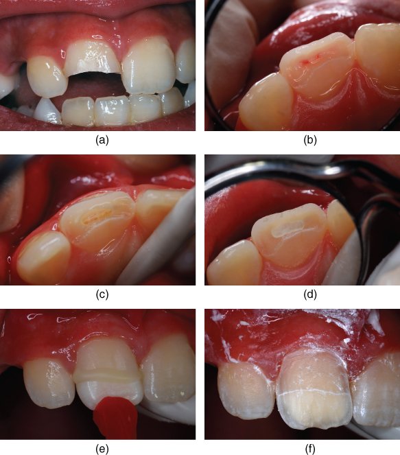 Pulpal Treatment In Young Permanent Incisors Following Traumatic Injuries Pocket Dentistry
