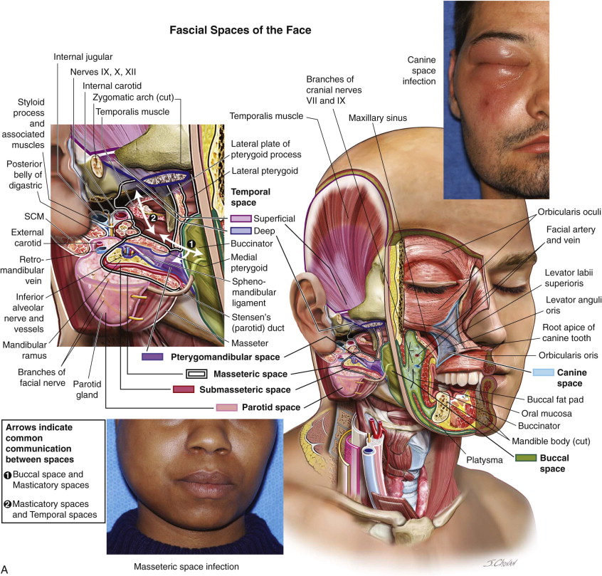 Fascial Spaces of the Head and Neck