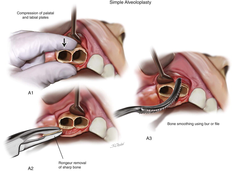 Alveoloplasty Pocket Dentistry