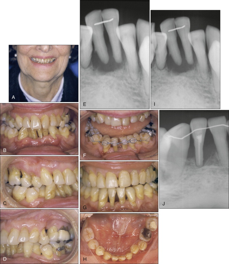 Orthodontic Treatment In Adult Patients With Reduced Periodontal ...