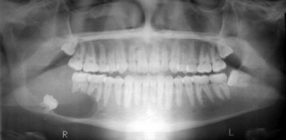 Contemporary Treatment of Ameloblastoma | Pocket Dentistry