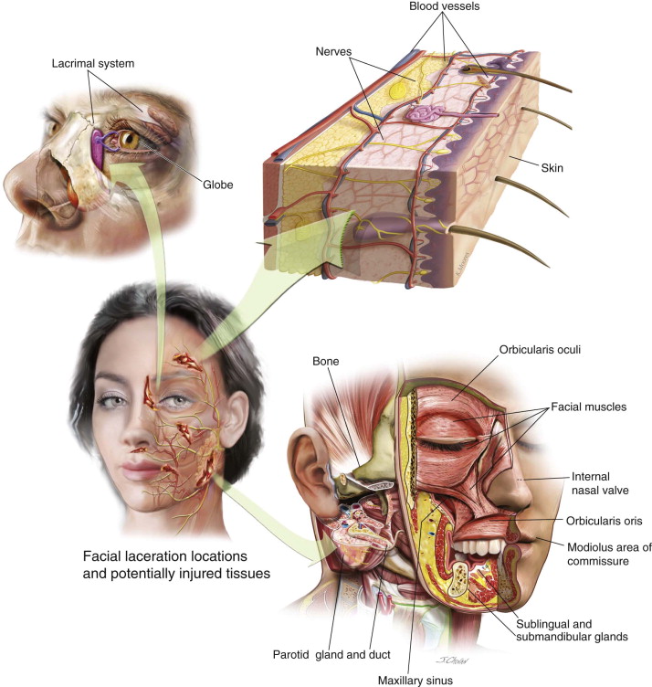 cheek laceration