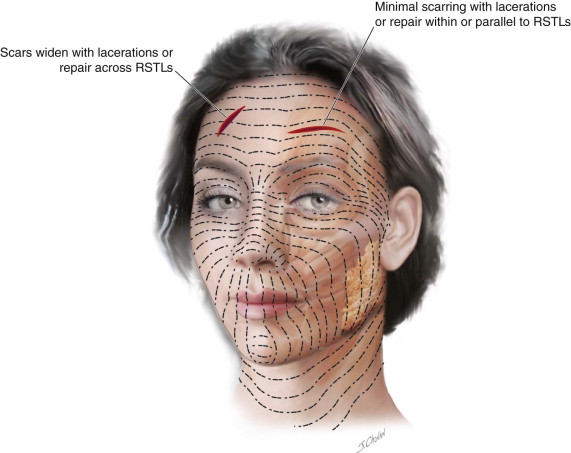 facial laceration