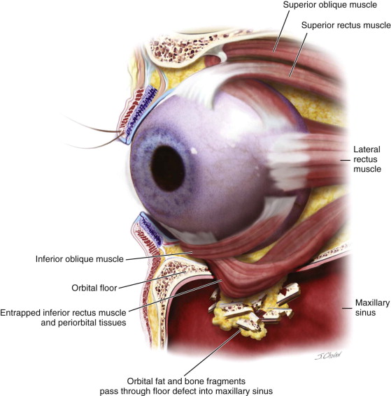 Orbital Fractures Pocket Dentistry