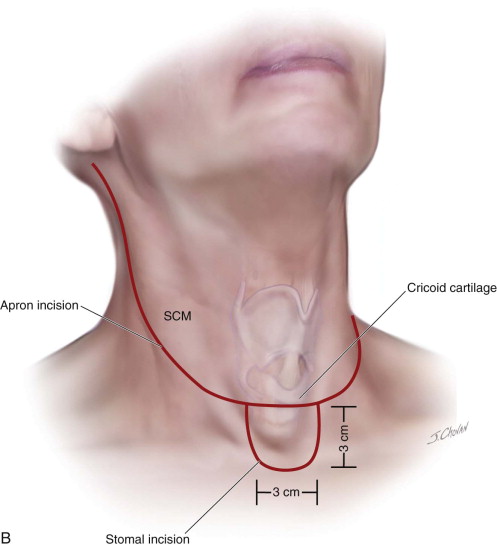 laryngectomy anatomy