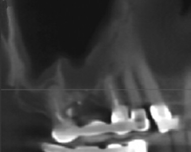 RADIOGRAPHY FOR DENTAL IMPLANTOLOGY | Pocket Dentistry