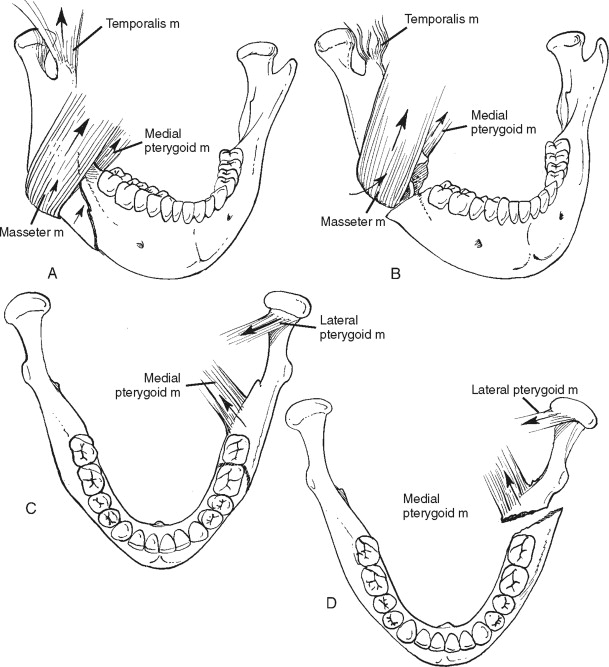 Fractures Of Mandible Classifications And Types - vrogue.co