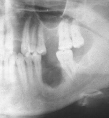 langerhans cell histiocytosis jaw