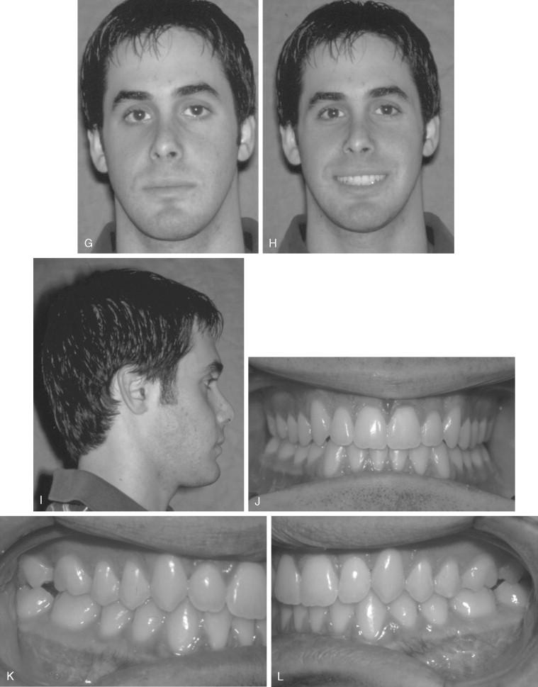 Asymmetrical face: Causes, treatment and more