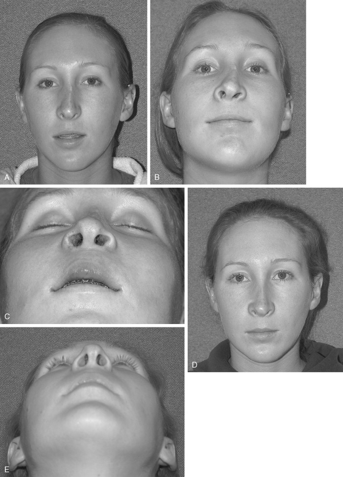 COMPLICATIONS WITH ORTHOGNATHIC SURGERY | Pocket Dentistry